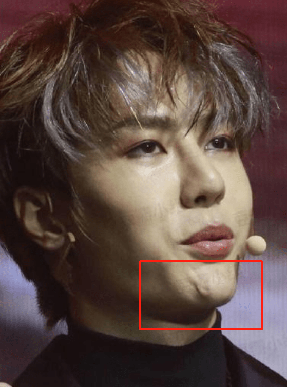 陈晓东脸部肿胀、五官扭曲，这些痴迷医美的男明星，不怕后遗症吗？？