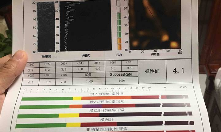 5kpa,脂肪衰减中位数210,是肝硬化吗_肝脏_弹性_进行