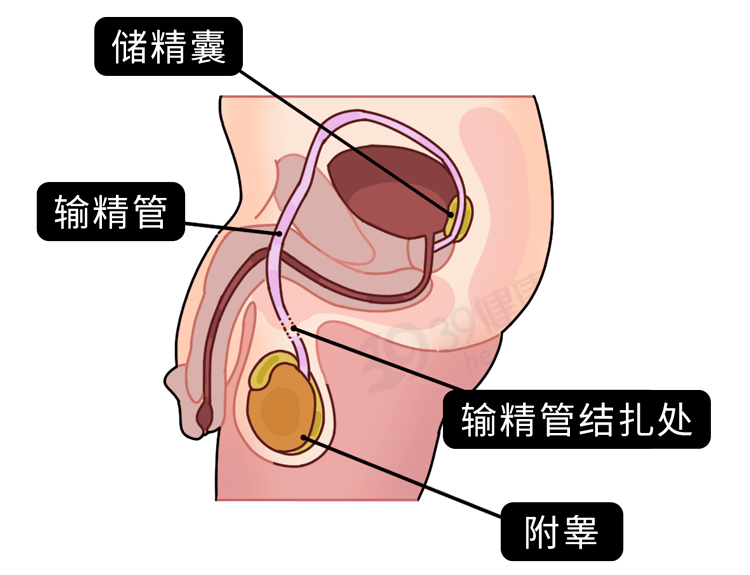 排出體外使精子無法進入輸精管內由睪丸運送精子往陰莖的輸精管男性