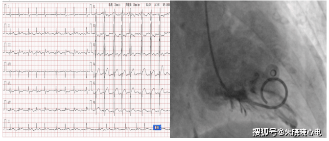 造影|3例胸痛、3份ST段抬高心电图，却是3个不同诊断！