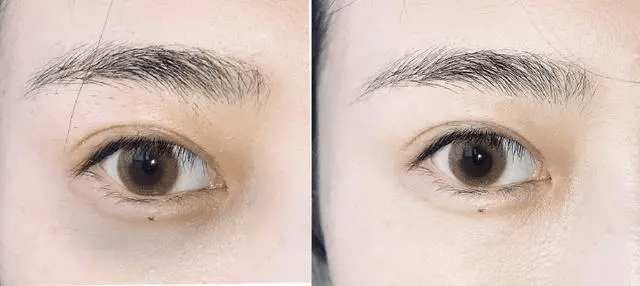 什么嗨体熊猫针是什么？一篇干货满满的「黑眼圈医美」分享