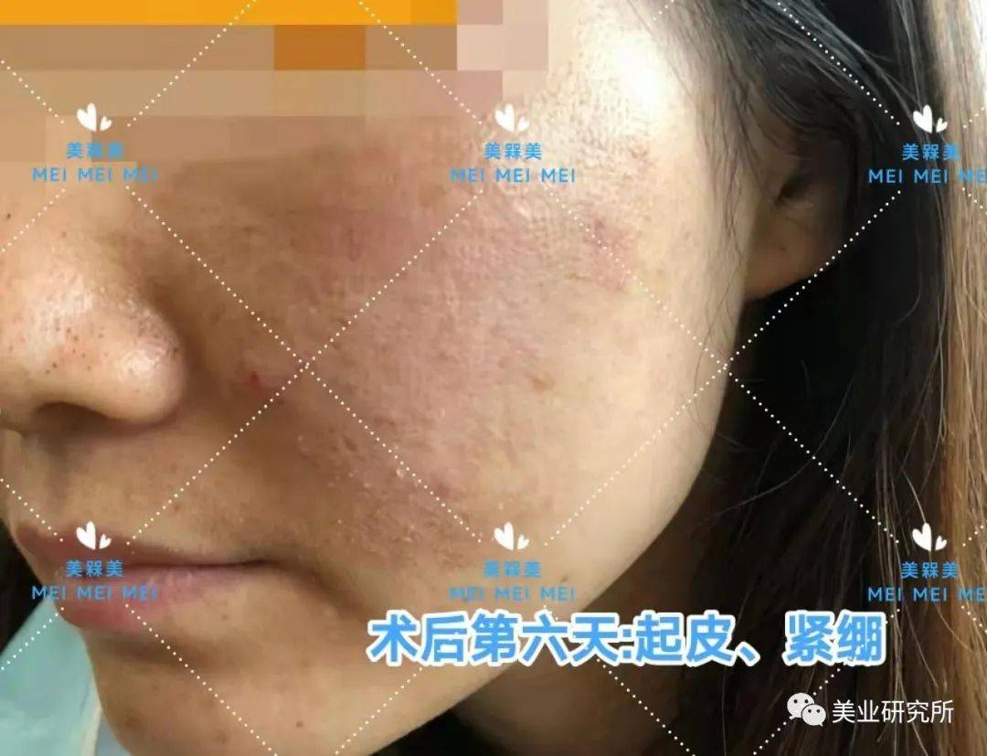 因为【美人汇】痘坑究竟该如何攻克？