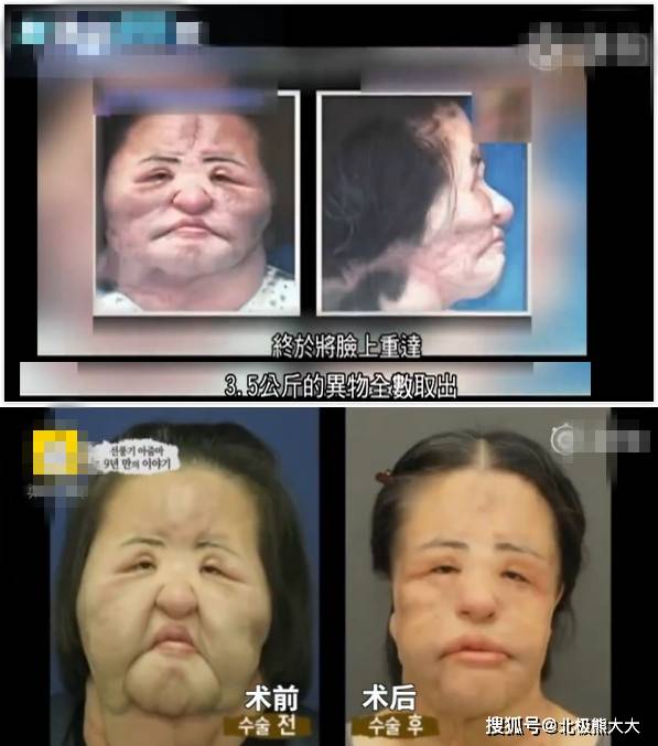 因为痴迷整容15年，把脸整成“电风扇”后遗症明显，韩慧景后悔了吗？