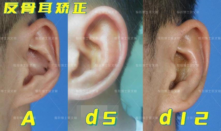 什么叫耳朵反骨 图片图片