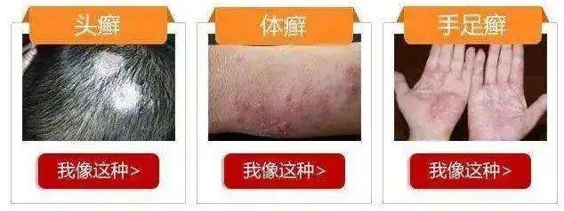 皮肤病的传染方式有哪些