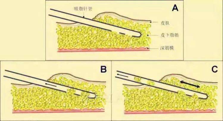 手术|小腿吸脂是否安全 看关几梦医生如何说