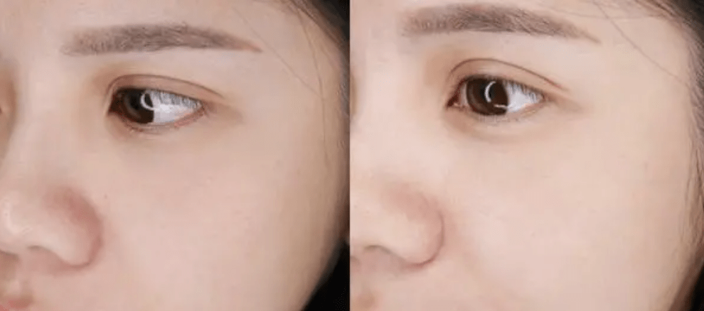 摩擦鼻翼两边总是泛红怎么办？记得做好这几件事，现在知道还来得及