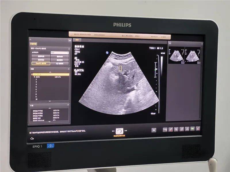 科普小达人——肝脏健康小管家 2_检查_超声_硬度