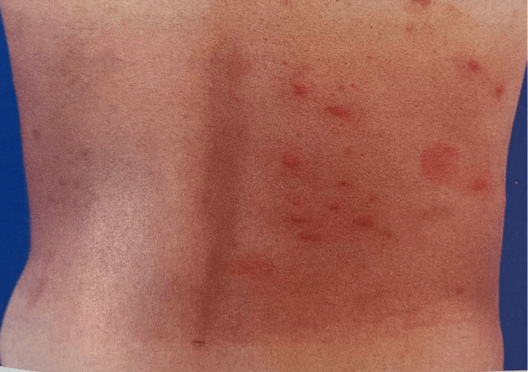 艾滋病初期红色斑疹图片