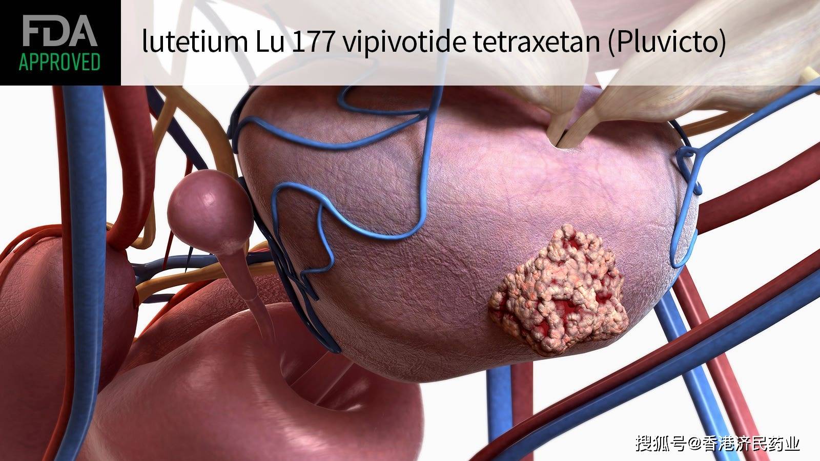 psma阳性前列腺癌新药fda批准靶向放射配体疗法pluvicto