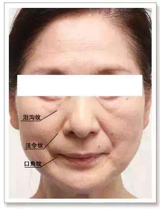 如果是皮肤确实很松弛了,口角囊袋都很明显了,脸型也出现了改变,则