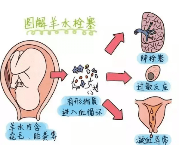 羊水栓塞有多可怕？这三类宝妈要注意，意外可能就在身边