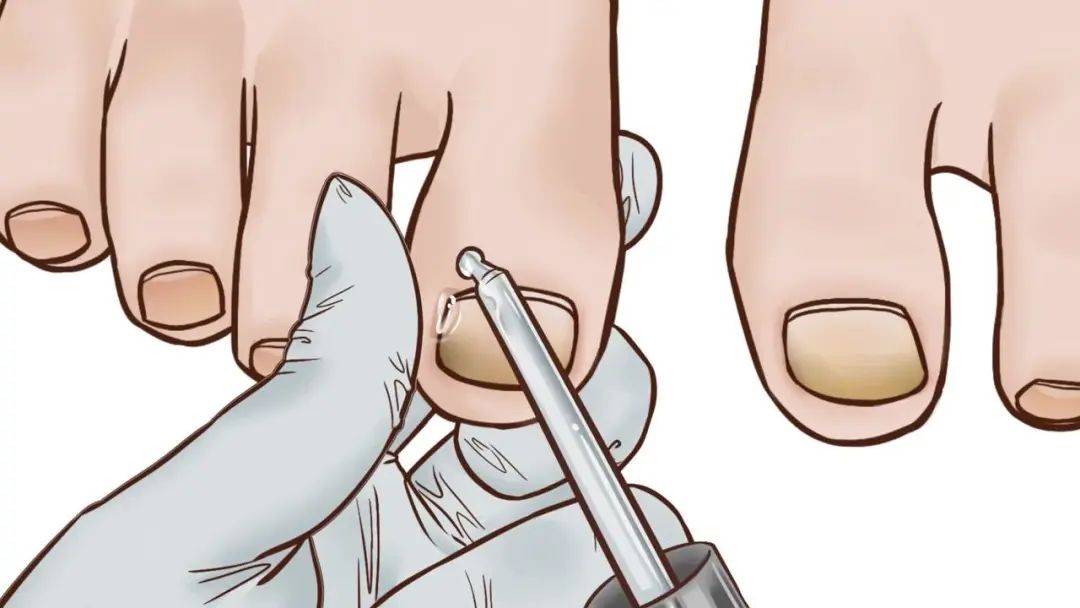 得了灰指甲只能拔甲这个谣言别再信了