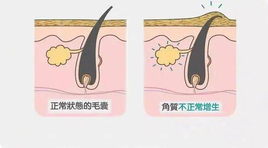 皮脂腺分泌旺盛鸡皮肤的简单介绍