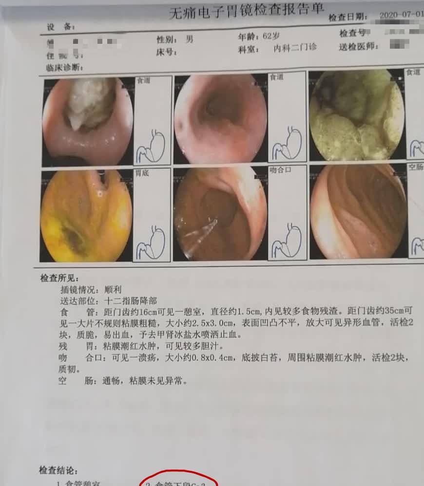 原创62岁老汉咽喉不适以为是咽炎却查出食道癌两者如何区分