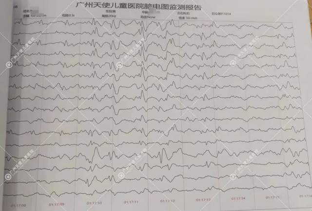 儿童良性癫脑电图图片
