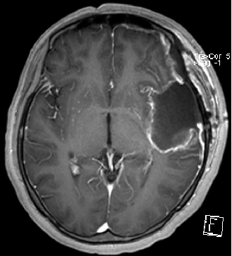 药店女子患上"左侧颞叶弥漫性星形细胞瘤"竟是熬夜导致的!