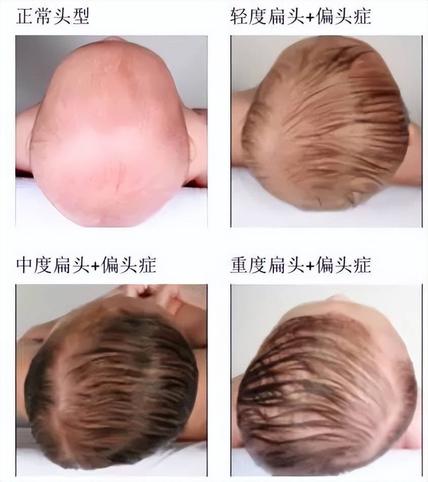舟状菱形头？妈妈吐槽宝宝头扁，开启宝宝圆头拯救记_搜狐网