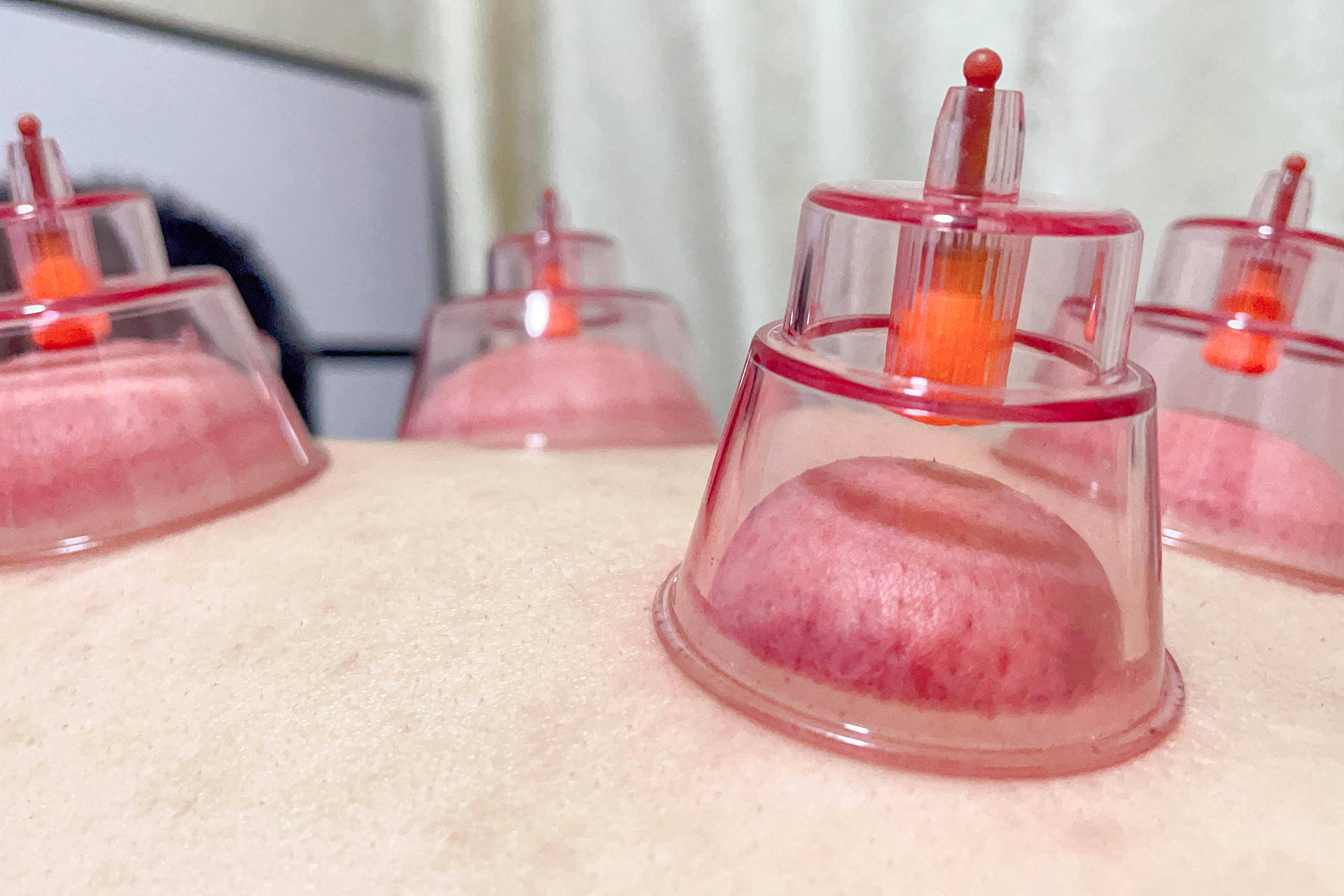 拔罐也要科技化拔罐走罐让设备精准保健