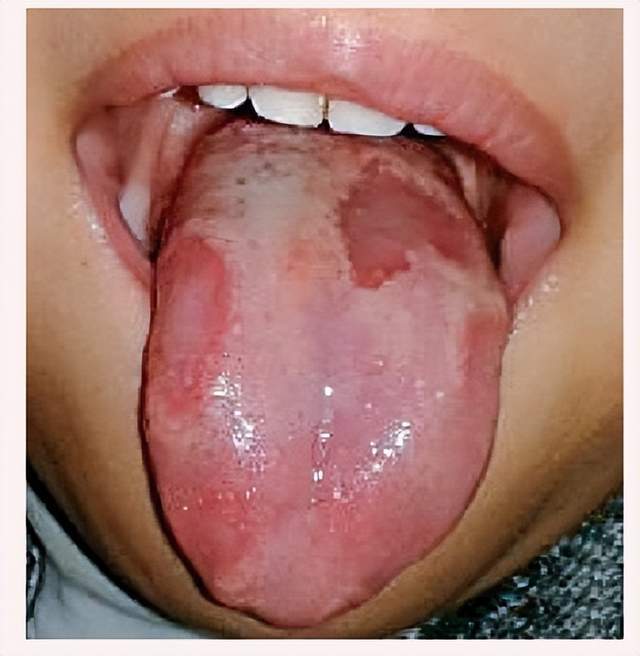 小孩舌头中间发红图片图片