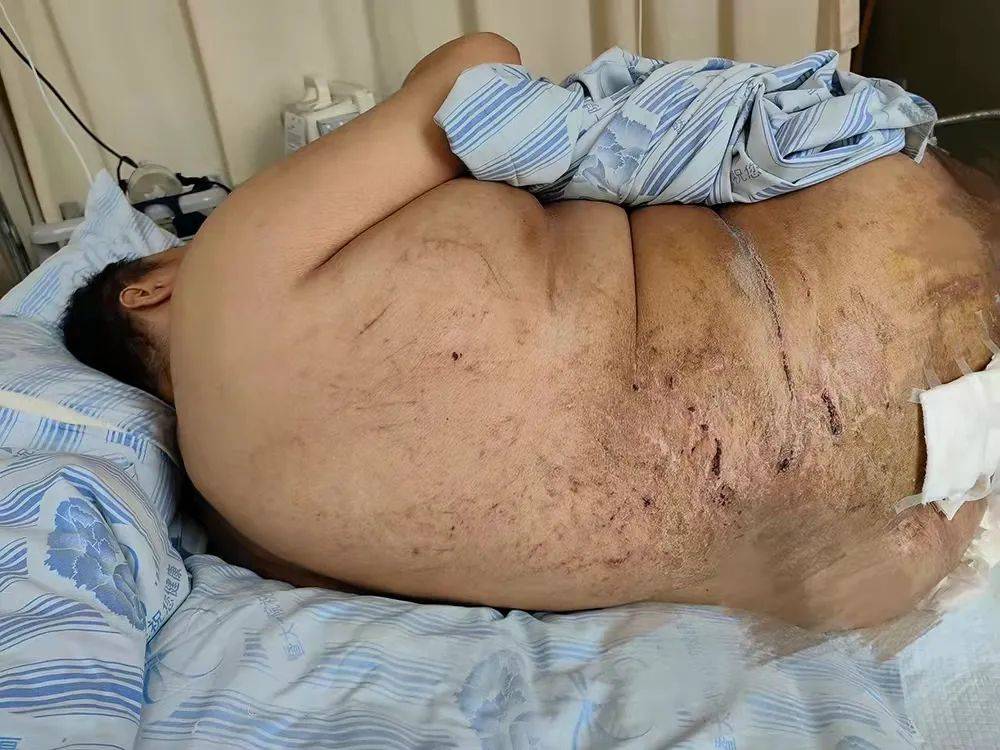 原创减重手术丨阳江第一胖龙哥终于可以向左转右臀大窟窿震惊在场医生