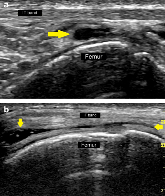 髂胫束综合症超声图像