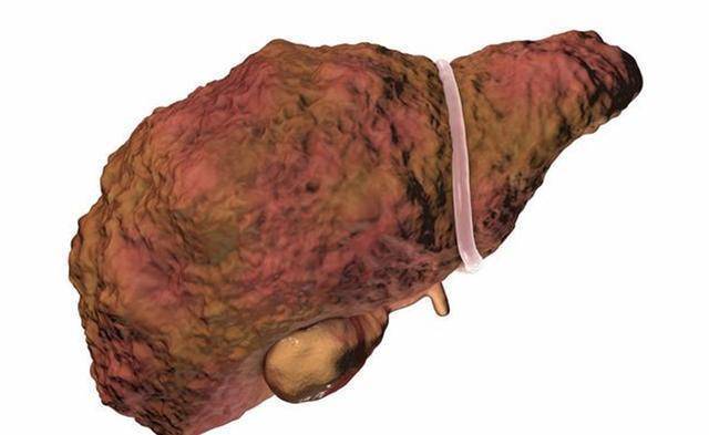 肝癌早期“不痛不痒”，皮肤出现3种变化，或是肝癌入侵