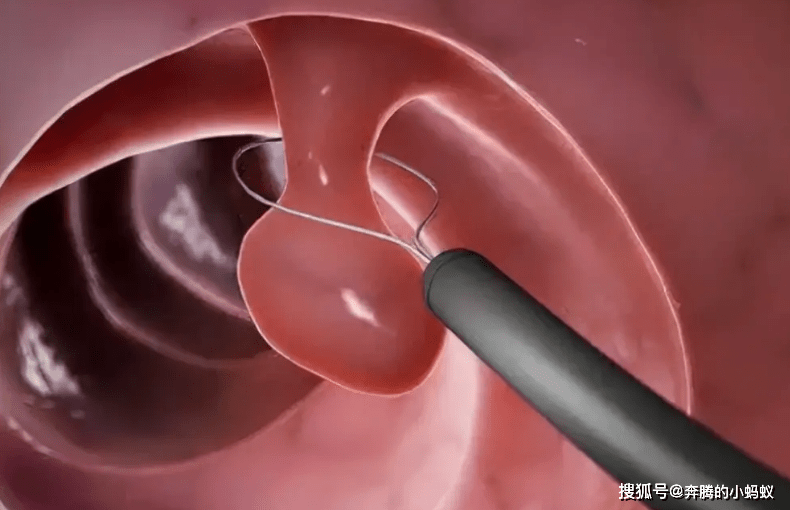 发现胃息肉,都要及时切除?弄清楚2件事,才好下定论!_癌变_患者_症状