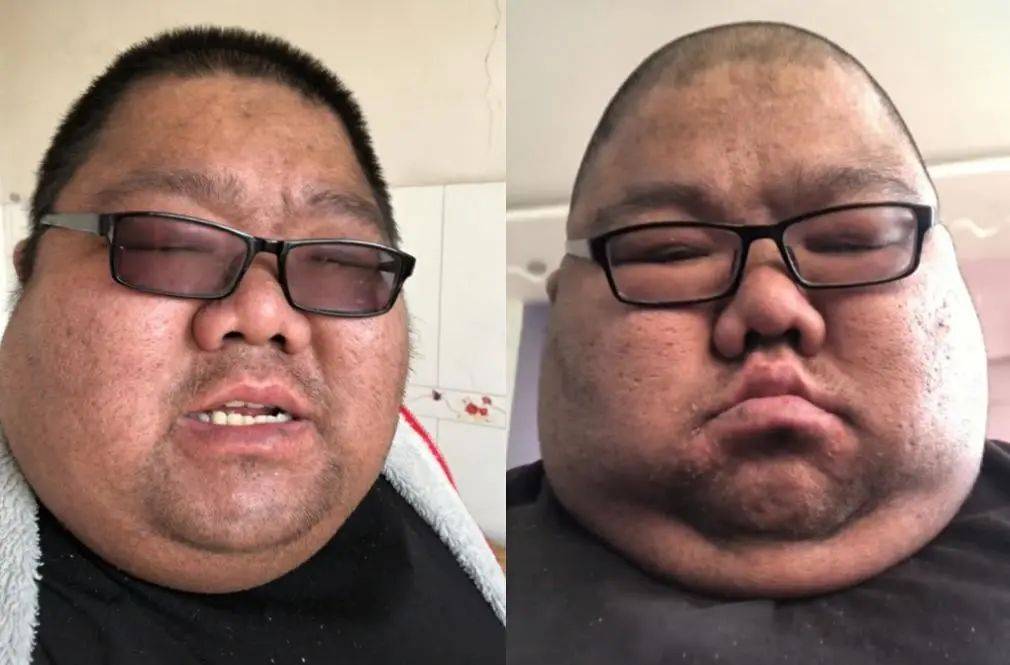 体重600斤,平时靠呼吸机吸氧,吃播网红胖猴子减肥瘦百斤_身体_闻味