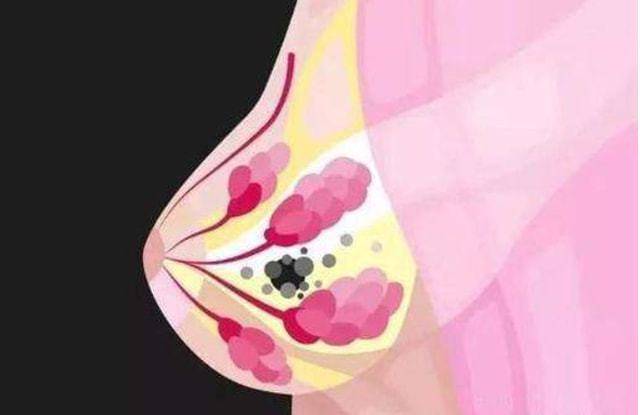 其实乳腺肿块是常见的乳房症状,除乳腺癌之外,多种良性疾病也会造成