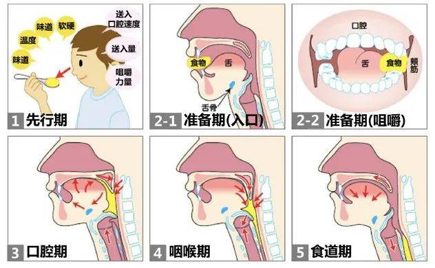 帕金森病患者出现吞咽困难后,因为唾液不能被咽下而蓄积在口腔里引发