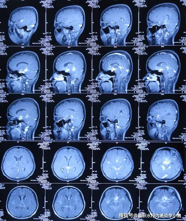 近致命性结核脑膜炎性脑积水发病后2个月内先后经4家医院治后仍无改善