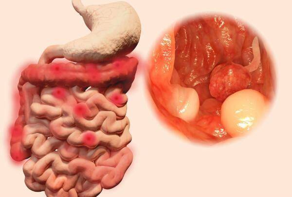 原創大腸息肉是怎麼形成的醫生或離不開這4個誘因儘量避免