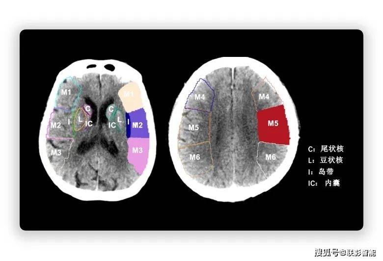ct 评分(alberta stroke program early ct score,aspects)是评价缺血