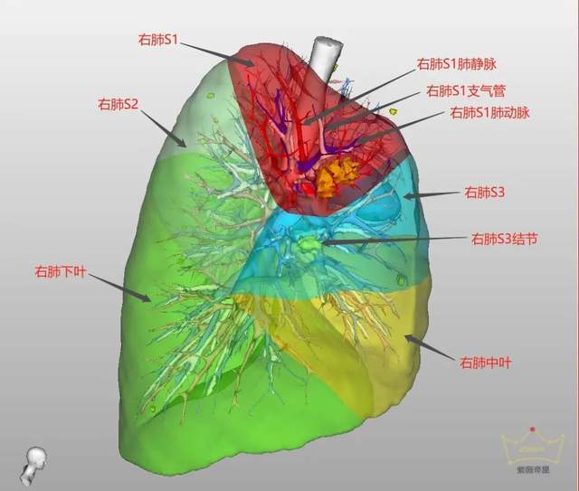 右肺支气管三维图图片