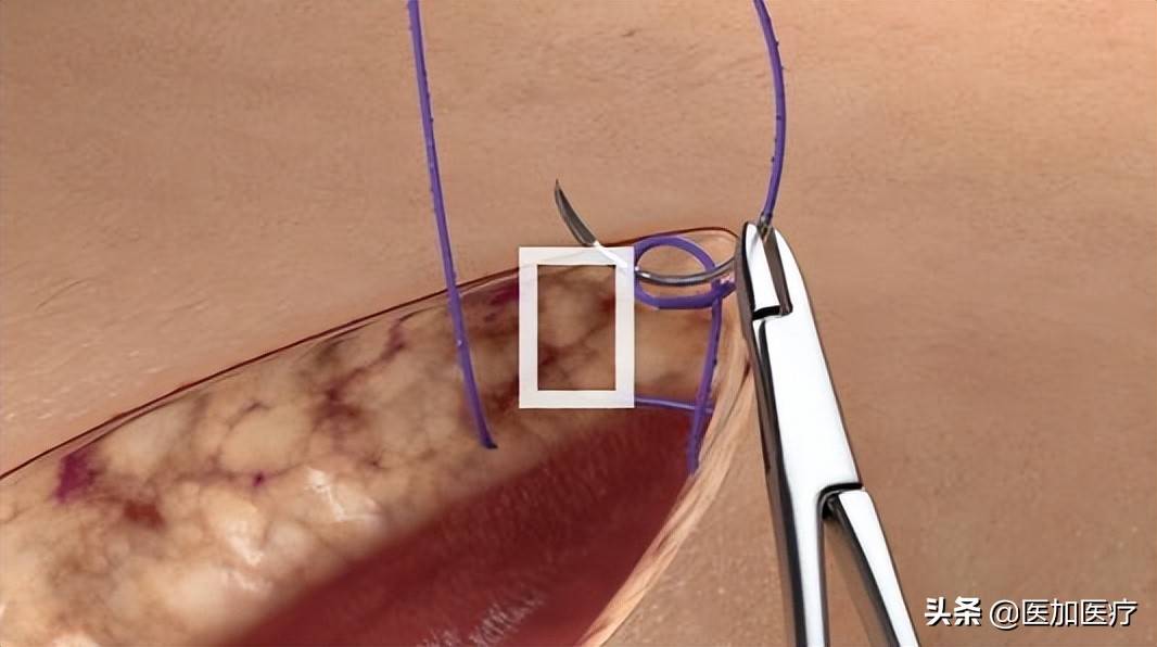 vlocl倒刺線的縫合方法及注意事項