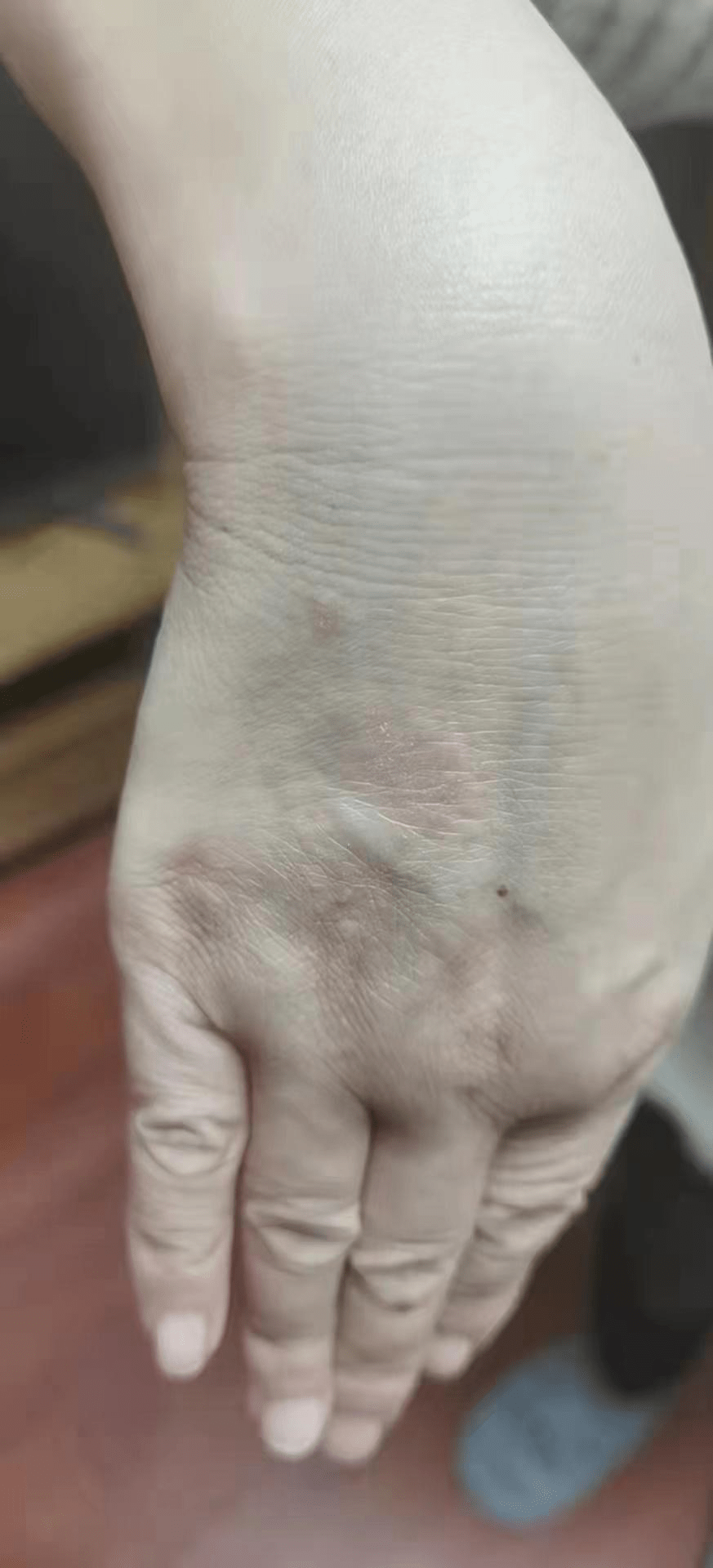 箹诗工坊干性湿疹手肘部位发痒