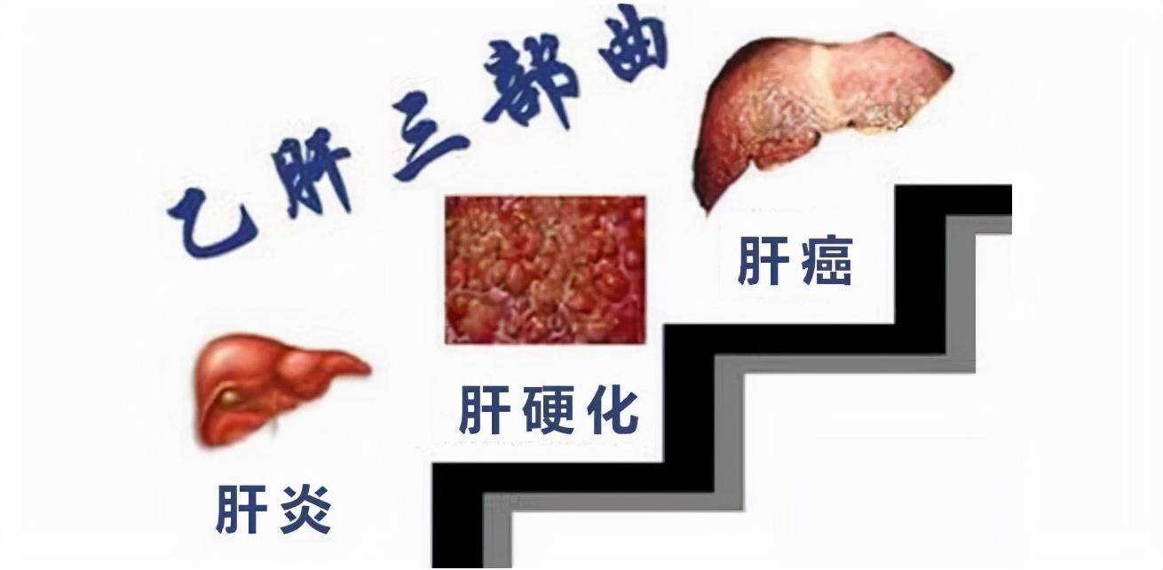 乙肝肝硬化肝癌是肝炎患者的必然宿命嗎4個堅持很關鍵