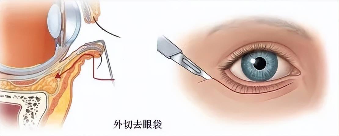 割完眼袋多久恢复自然割眼袋手术后需要注意什么牛啊