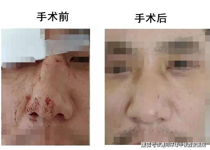 我院成功救治一例复合性鼻骨骨折患者 鼻中隔 损伤 先生