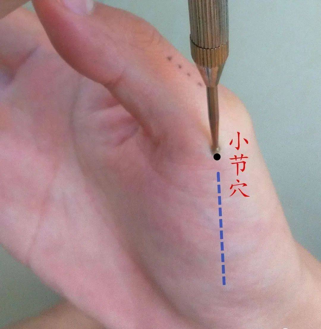 男的扎双申脉,女的扎双照海,照海男的用左,申脉女的用右.注:文中