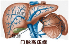 肝硬化門脈高壓切脾就好了嗎李亞磊標本兼治