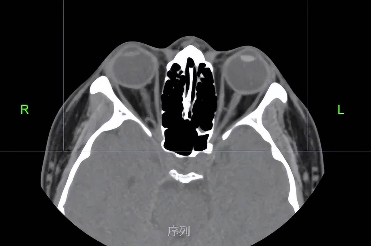 眼外伤的后遗症 ——谈谈外伤性白内障_右眼_晶状体_儿童