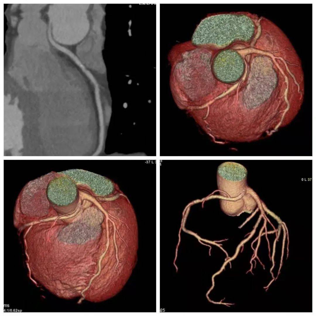 影像技术心脏守护者冠脉cta让心脏血管病变无处遁形