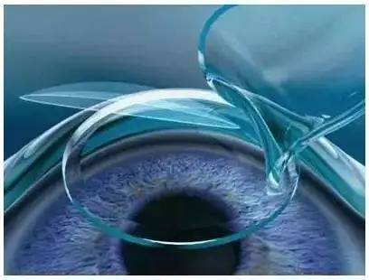 半飞秒手术效果怎么样重庆可以做半飞秒的医院推荐飞秒价格收费