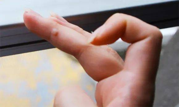 亚型_癌变_丘疹