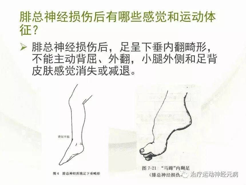 腓总神经损伤常见病因及中医辨证