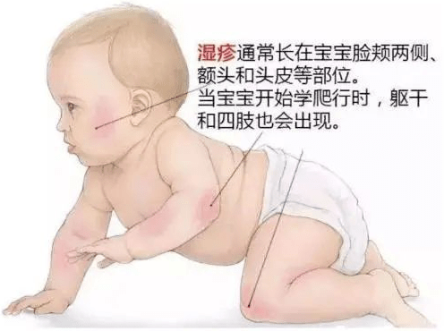 【婴儿湿疹】婴儿湿疹的原因_婴儿湿疹怎么办