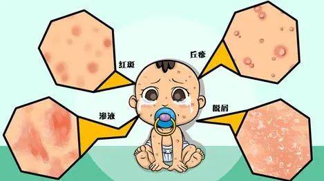 【婴儿湿疹】婴儿湿疹的原因_婴儿湿疹怎么办