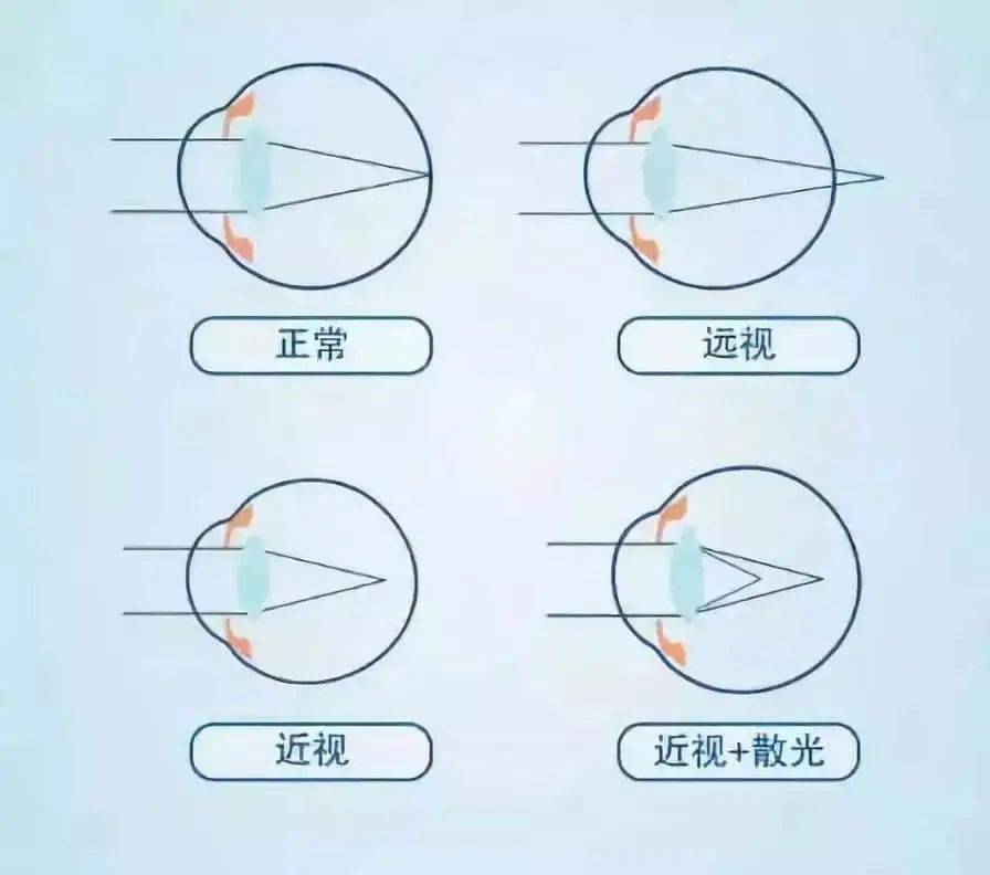 远视储备有多重要? 一旦不足,就可能近视